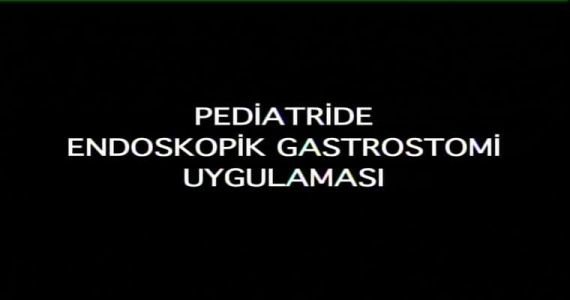 Pediatride Endoskopik Gastrostomi Uygulaması